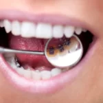 12 فایده و مزیت ارتودنسی دندان به جز زیبایی لبخند