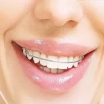 Four Benefits of Orthodontic Treatment