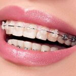 The Most Important Rules for Anyone with Braces